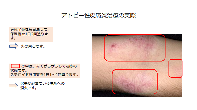 アトピー性皮膚炎の実際